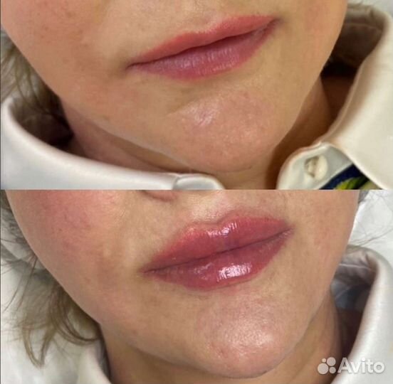 Увеличение губ