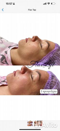 Безинъекционный лифтинг Flax Lift