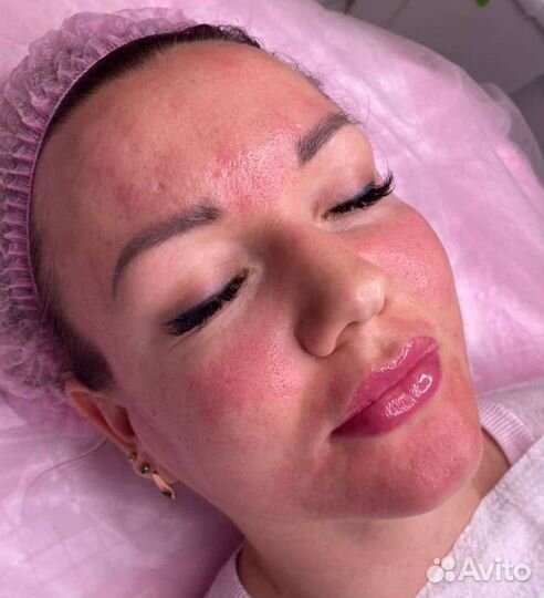 Увеличение губ