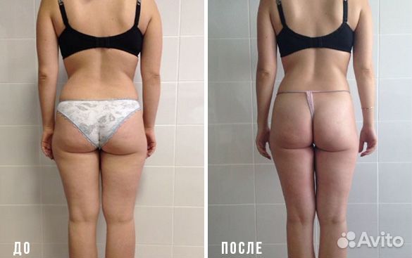 Модель на эндосферу тела / аппаратный массаж