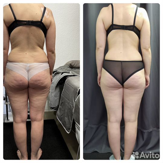 Lpg массаж тело и лицо