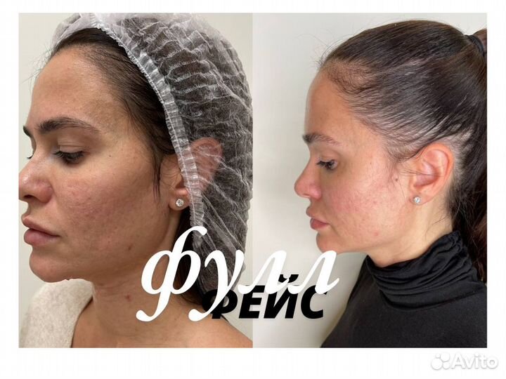 Лицо под ключ новое лицо косметология ботокс