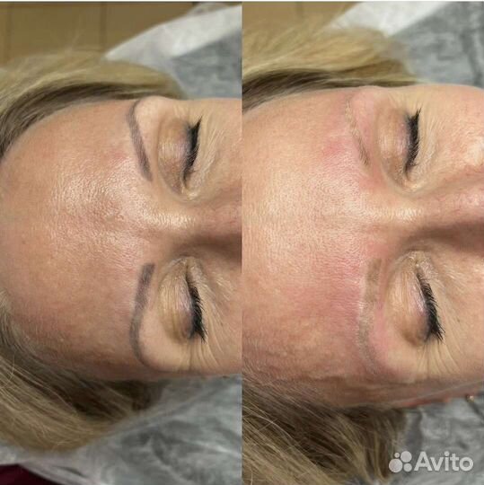 Лазерное удаление тату