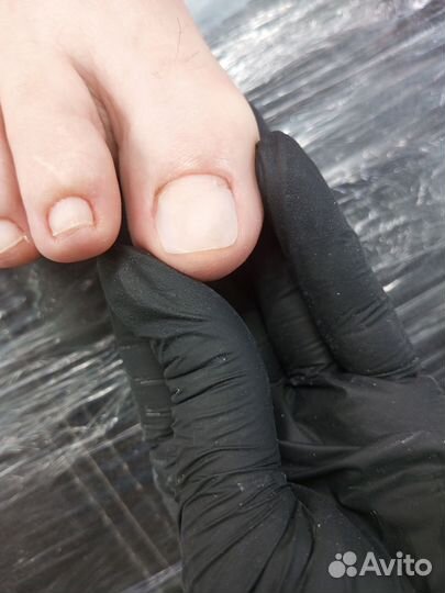 Протезирование ногтя. Титановая нить. Подолог