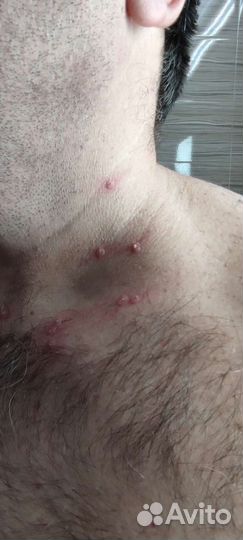 Удаление папиллом, бородавок