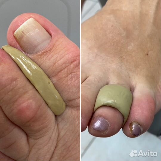 Подологический уход любой сложности