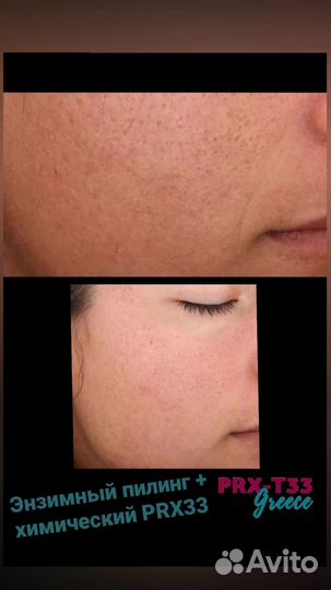 Карбокситерапия