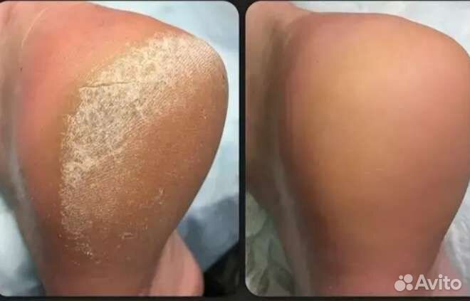 Педикюр мужской