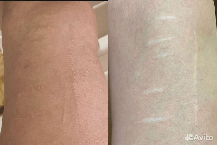 Камуфляж шрамов, ореол. Перекрытие татуажа