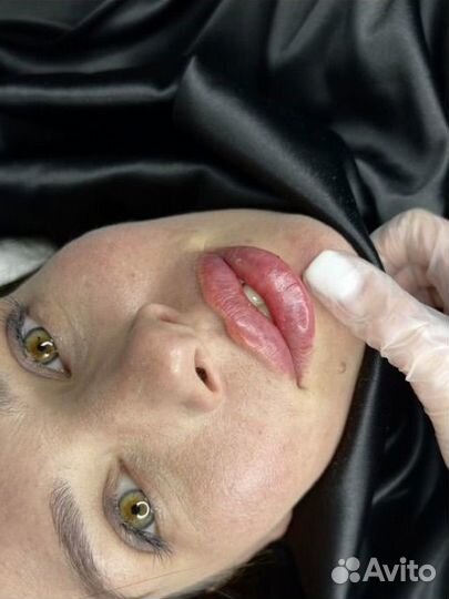 Увеличение губ