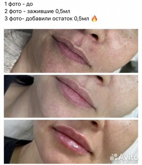 Увеличение губ