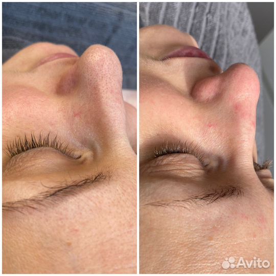 Чистка лица, массаж, дермапен