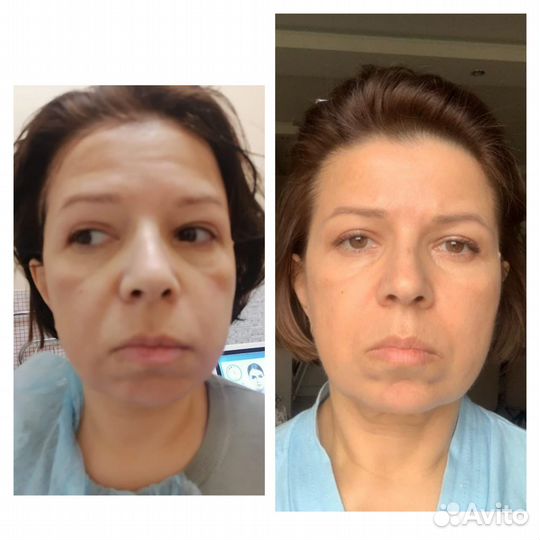 Смас-лифтинг