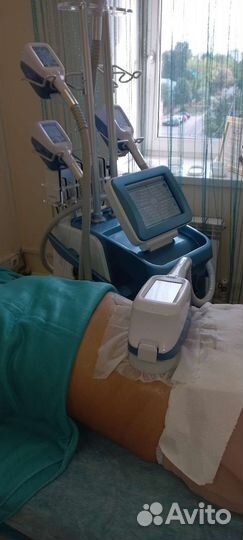 Криолиполиз/Локальное удаление жира