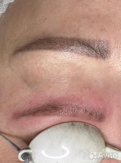 Удаление татуажа