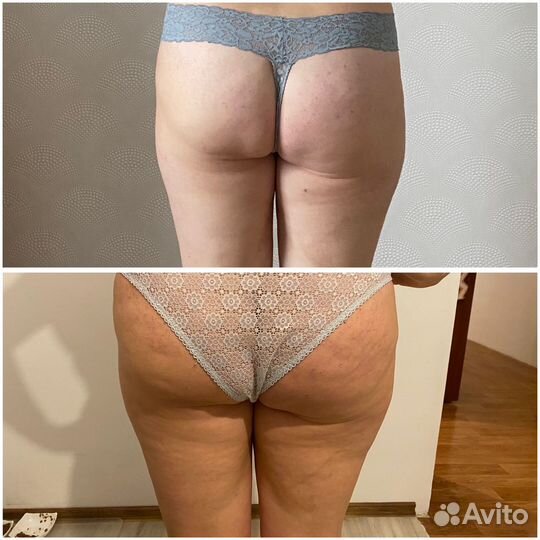 Аппаратный массаж, коррекция тела