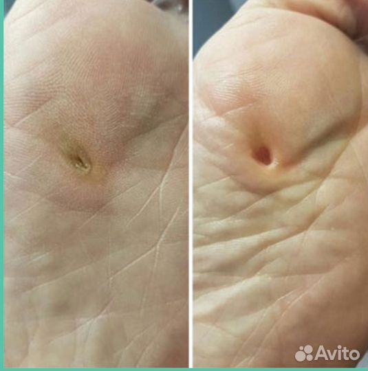 Стержневая мозоль