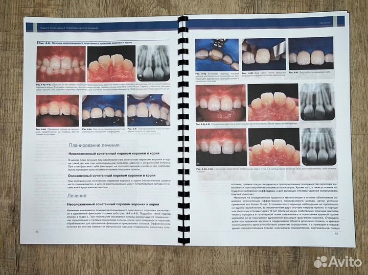 Травма зубов
