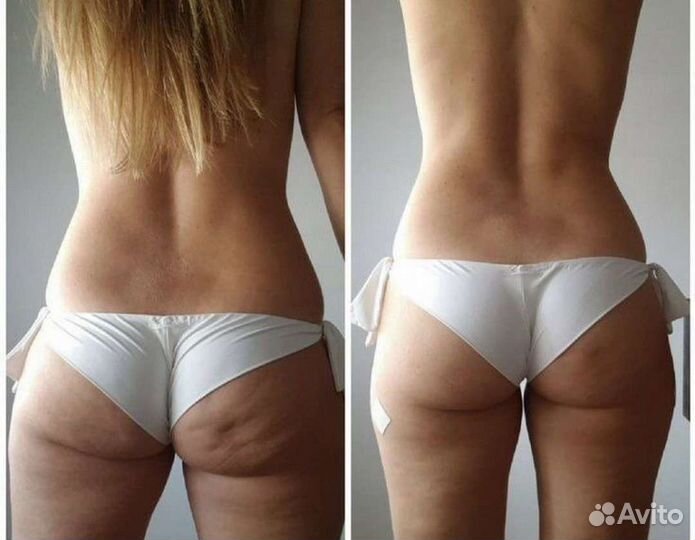 Emsculpt процедура (прокачка мышц )