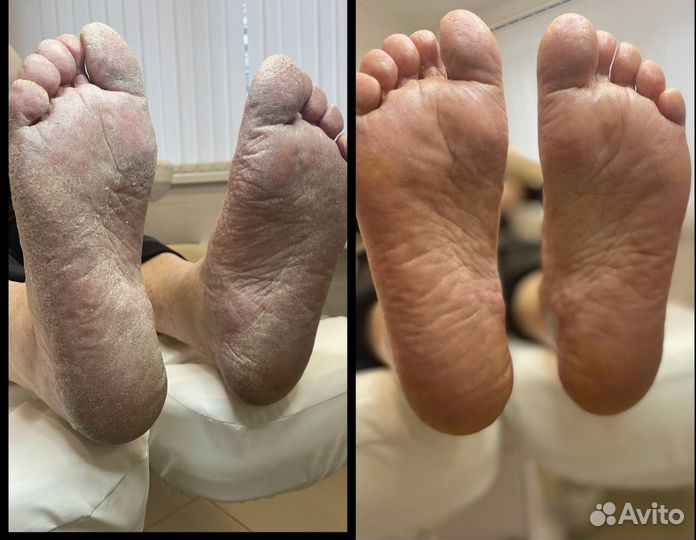 Подолог Педикюр Титановая нить