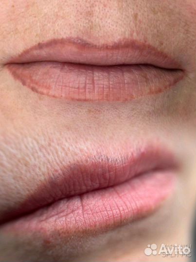 Удаление татуажа