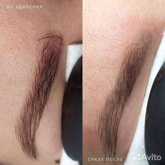 Удаление татуажа лазером, ремувером