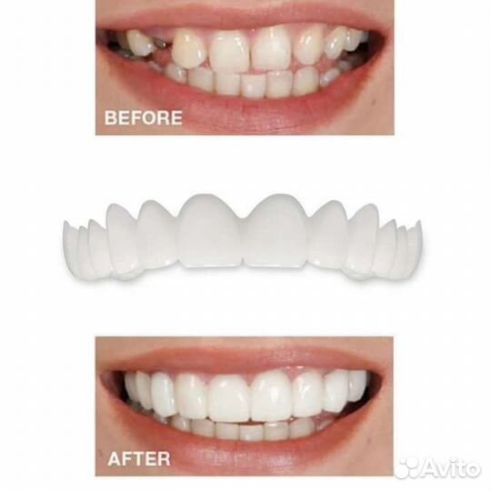 Съёмные зубы, Виниры для зубов