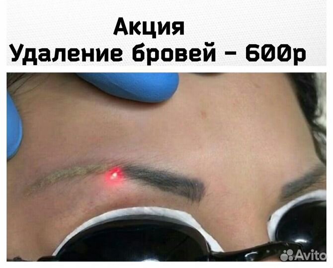 Удаление татуажа татуировок