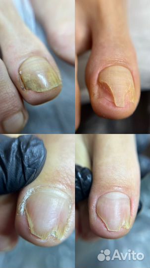 Модель на вросший ноготь
