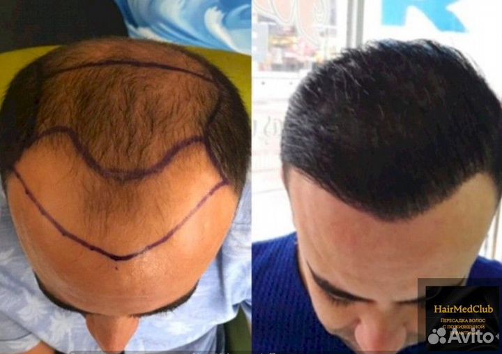 Пересадка волос с пожизненной гарантией