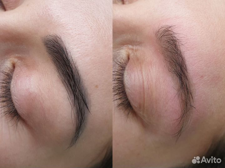 Удаление татуажа, микроблэйдинга