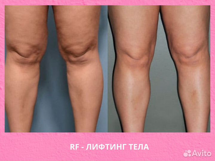 Обучение аппаратной косметологии с нуля