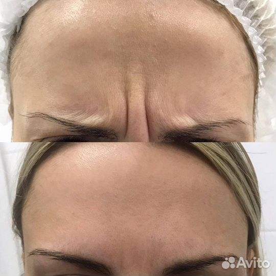 Инъекции ботокса в лоб