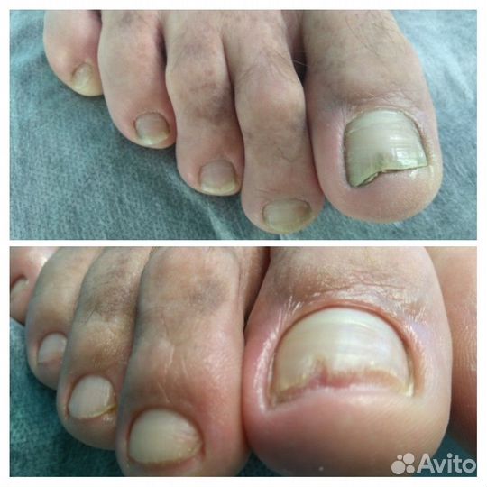 Подолог. Педикюр, ноги, ногти. Уход стопы