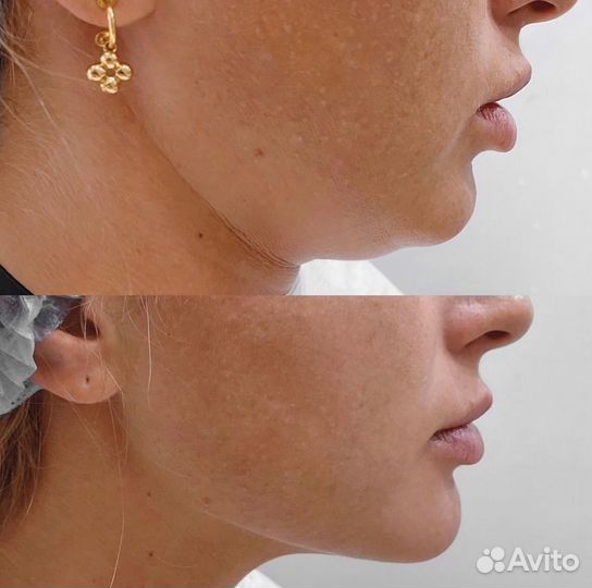 Липолитики, худое лицо, стройное тело, жиротоп