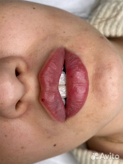 Увеличение губ