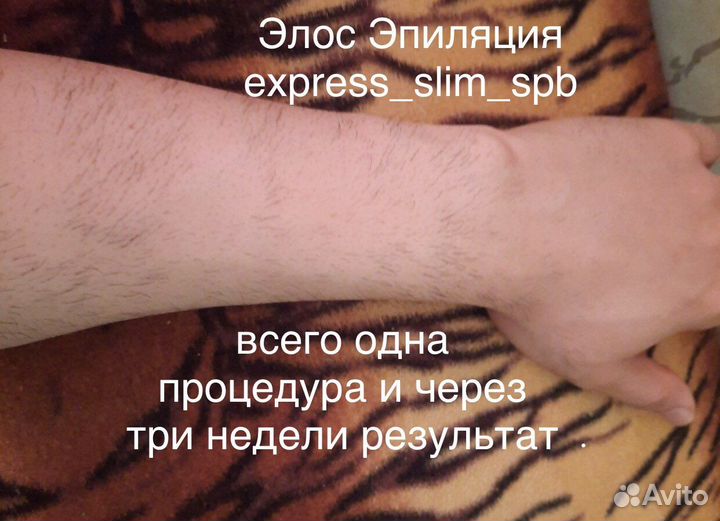 Лазерная Элос Эпиляция