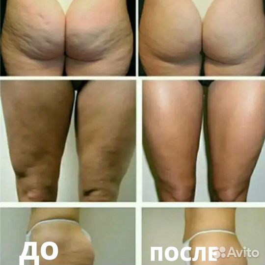 Антицеллюлитный массаж