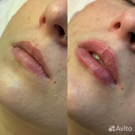Врач-косметолог: чистка лица, бта, увеличение губ
