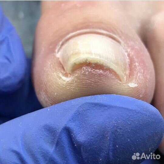 Модели на титановую нить при вросшем ногте