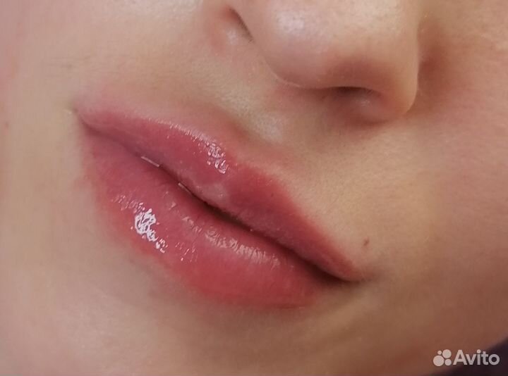 Увеличение губ