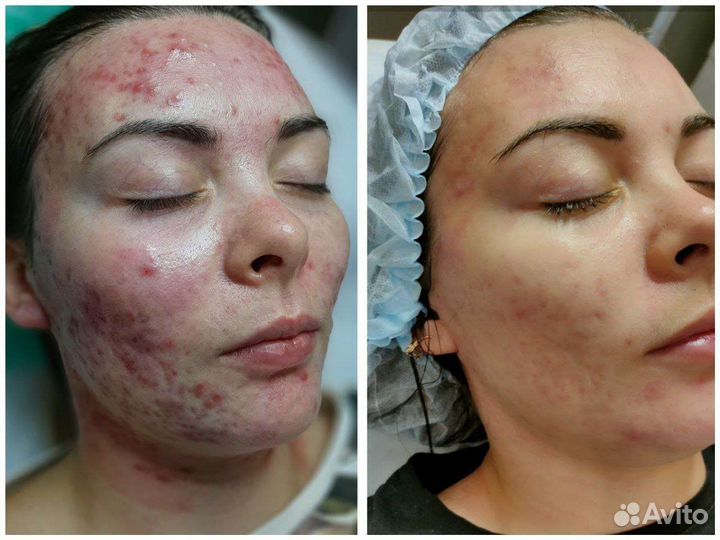 Плазмолифтинг