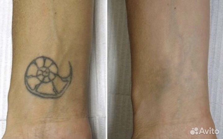 Удаление татуировок