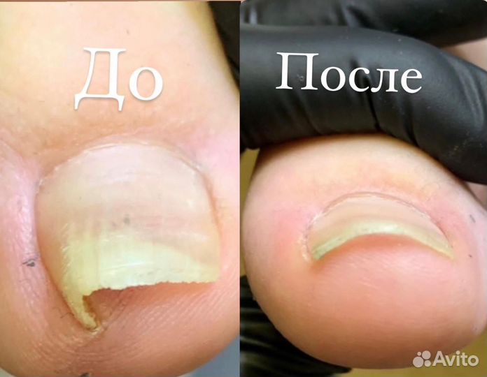 Подологический педикюр