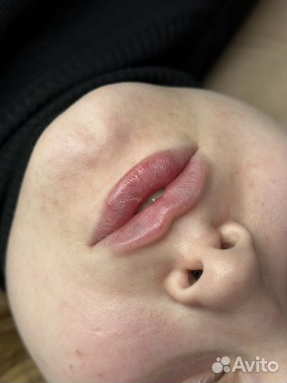 Увеличение губ, ботокс, липолитики, углы