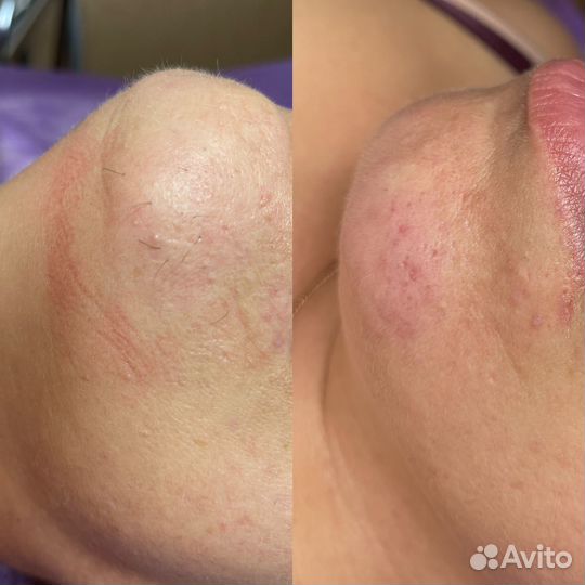 Электроэпиляция