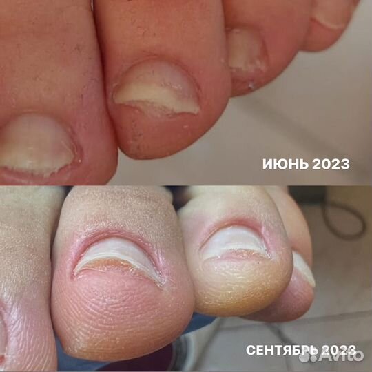 Лечебный педикюр, подолог