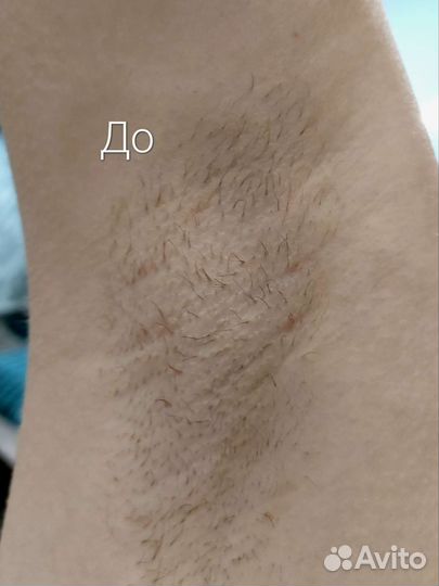 Шугаринг депиляция