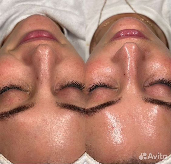 Карбокситерапия oily balance