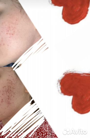 Болтушка Skin Care от проблемной кожи